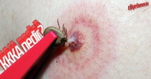 KKKA nedir? Kene ısırınca ne yapılmalı?