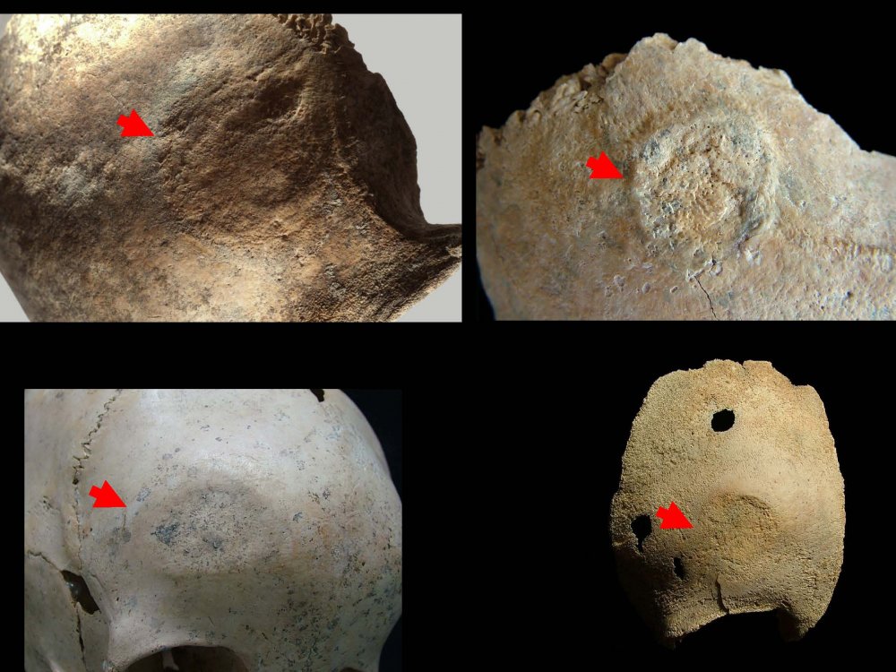 Samsunda 5 Bin Yil Once Moda Icin Kafatasi Ameliyati Yapilmis Jpg